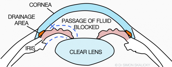 14. Narrow drainage angles