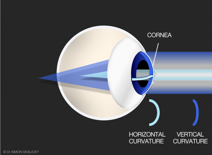 5. astigmatism