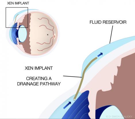 Image result for trabeculectomy