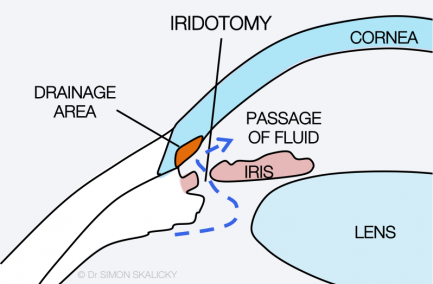 17. iridotomy
