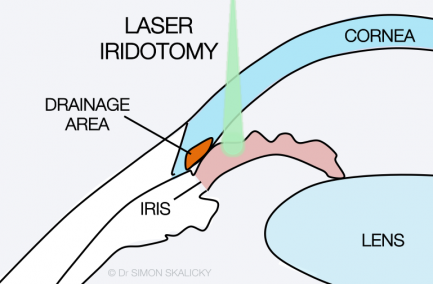 15. laser iridotomy