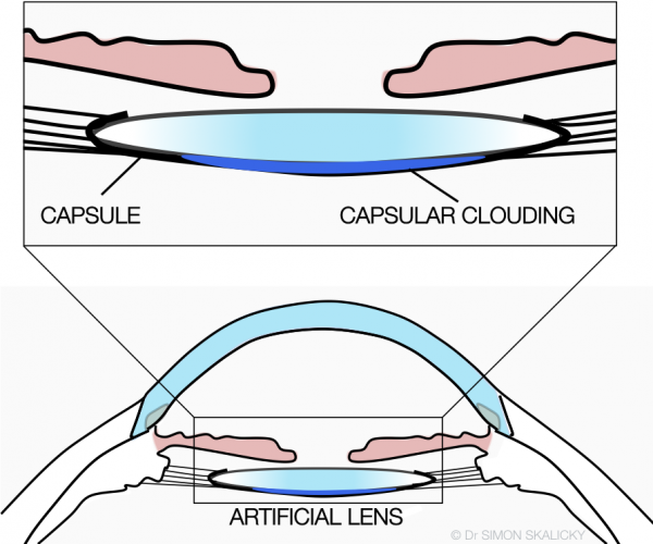 6. capsular clouding