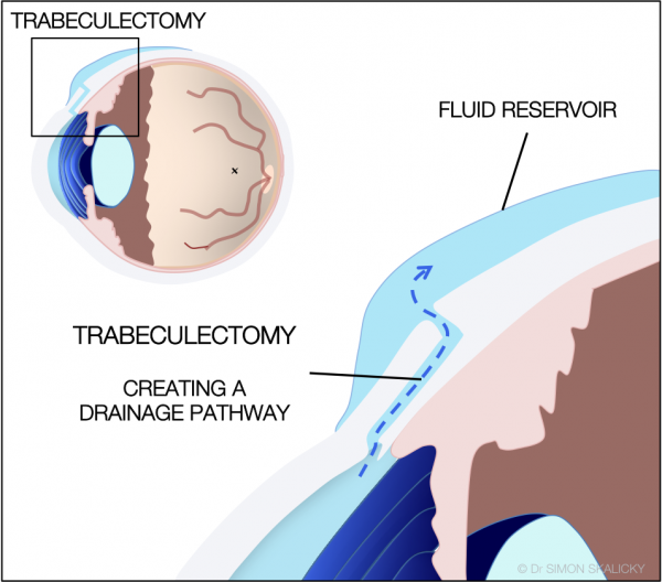 17. Trabeculectomy