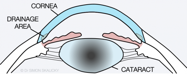 4. cataract